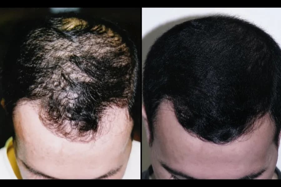 Hair Scripts patient before and after result