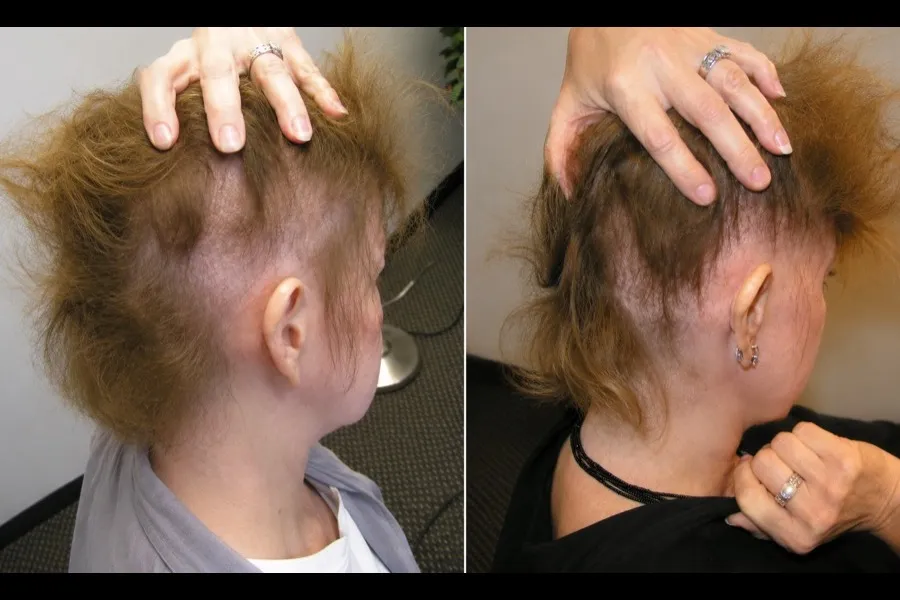 Hair Scripts patient before and after result