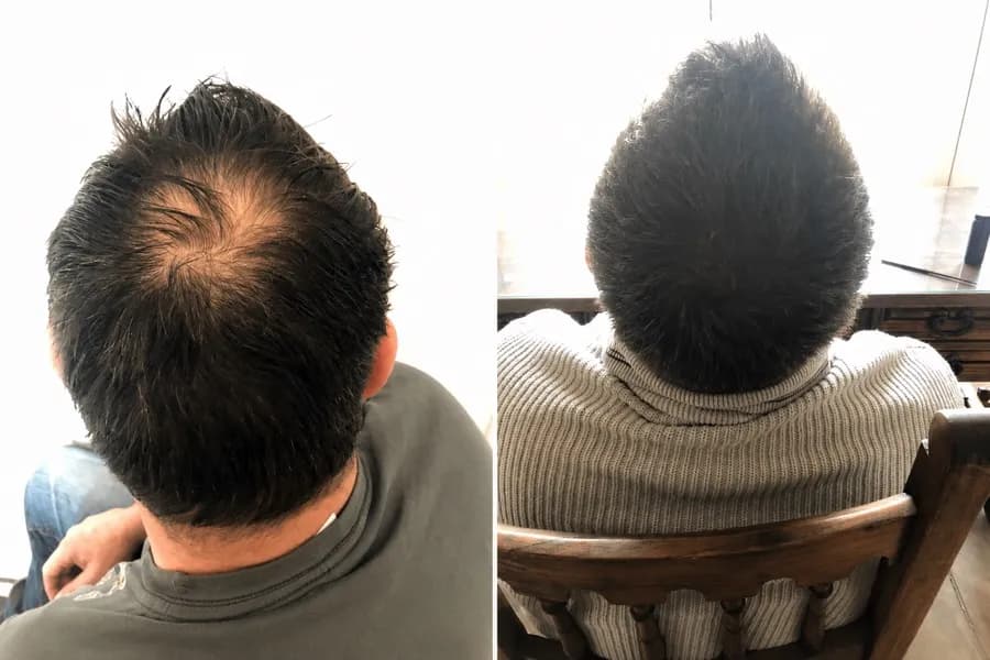 Hair Scripts patient before and after result