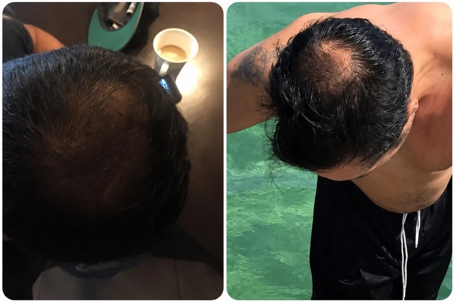 Hair Scripts patient before and after result