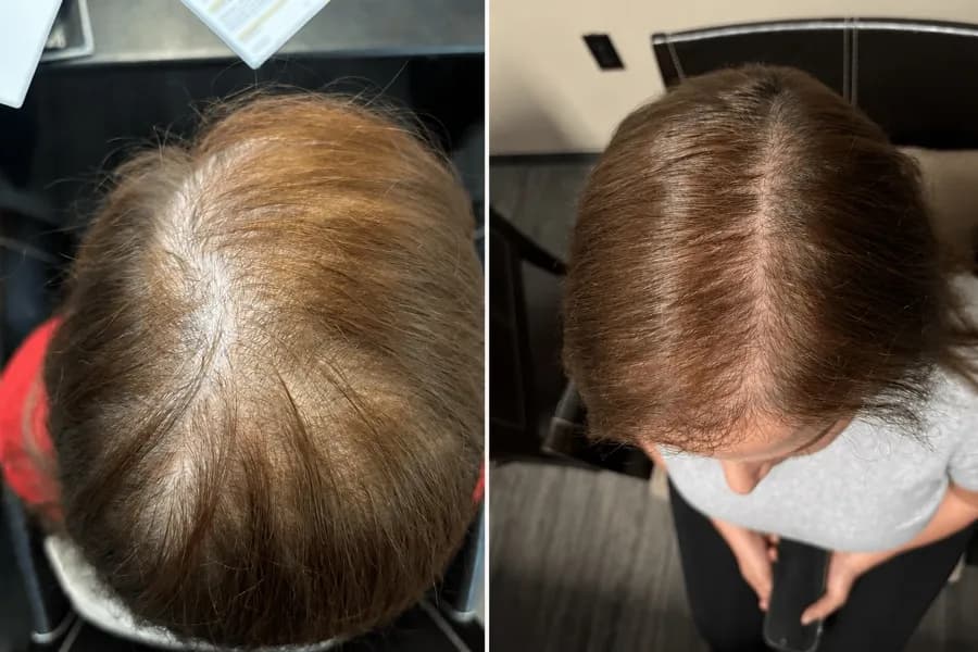 Hair Scripts patient before and after result