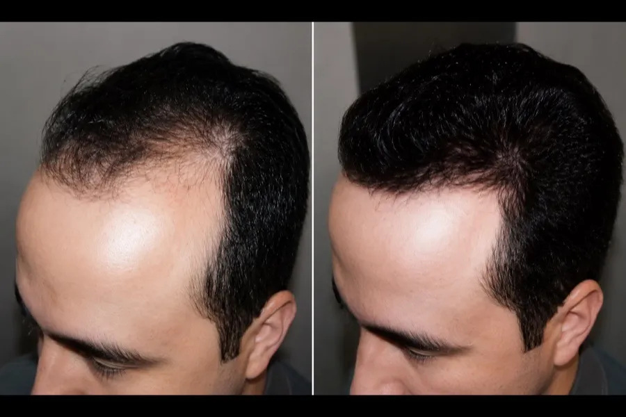 Hair Scripts patient before and after result