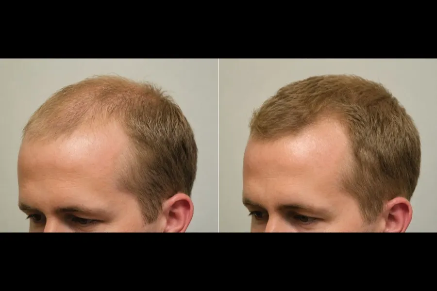 Hair Scripts patient before and after result